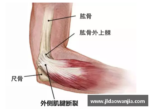 游艇会yth球员跟腱拉伤：预防与康复策略详解